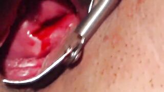 show my cervix and speculum vaginal in menstrual period