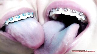 Youthful brace lesbos tounge giving a kiss